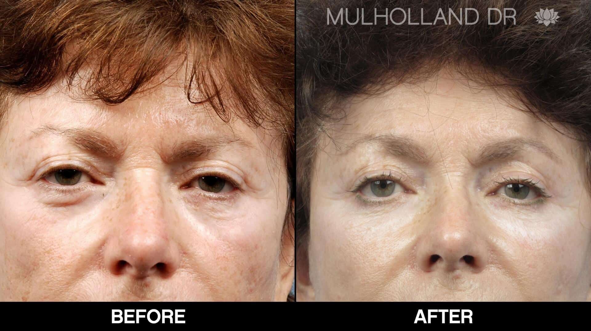 Fractional Erbium Laser - Before and After Gallery - Patient Photo 47