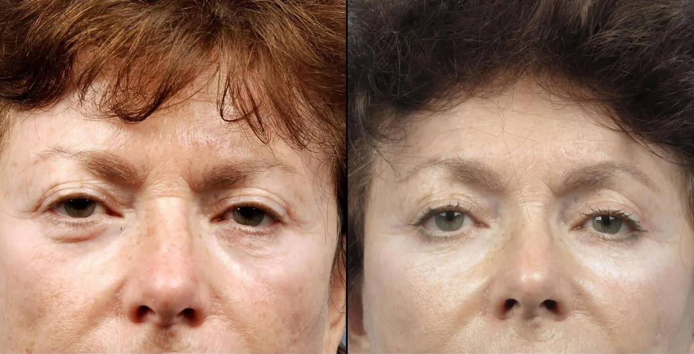 Fractional Erbium Laser - Before and After Gallery - Patient Photo 47