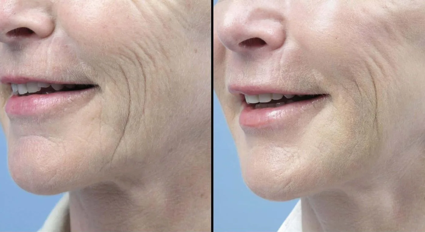 Fractional Erbium Laser - Before and After Gallery - Patient Photo 5