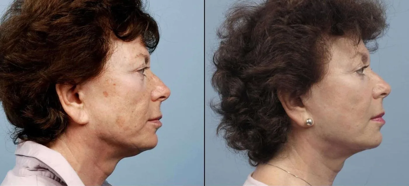 Fractional Erbium Laser - Before and After Gallery - Patient Photo 50