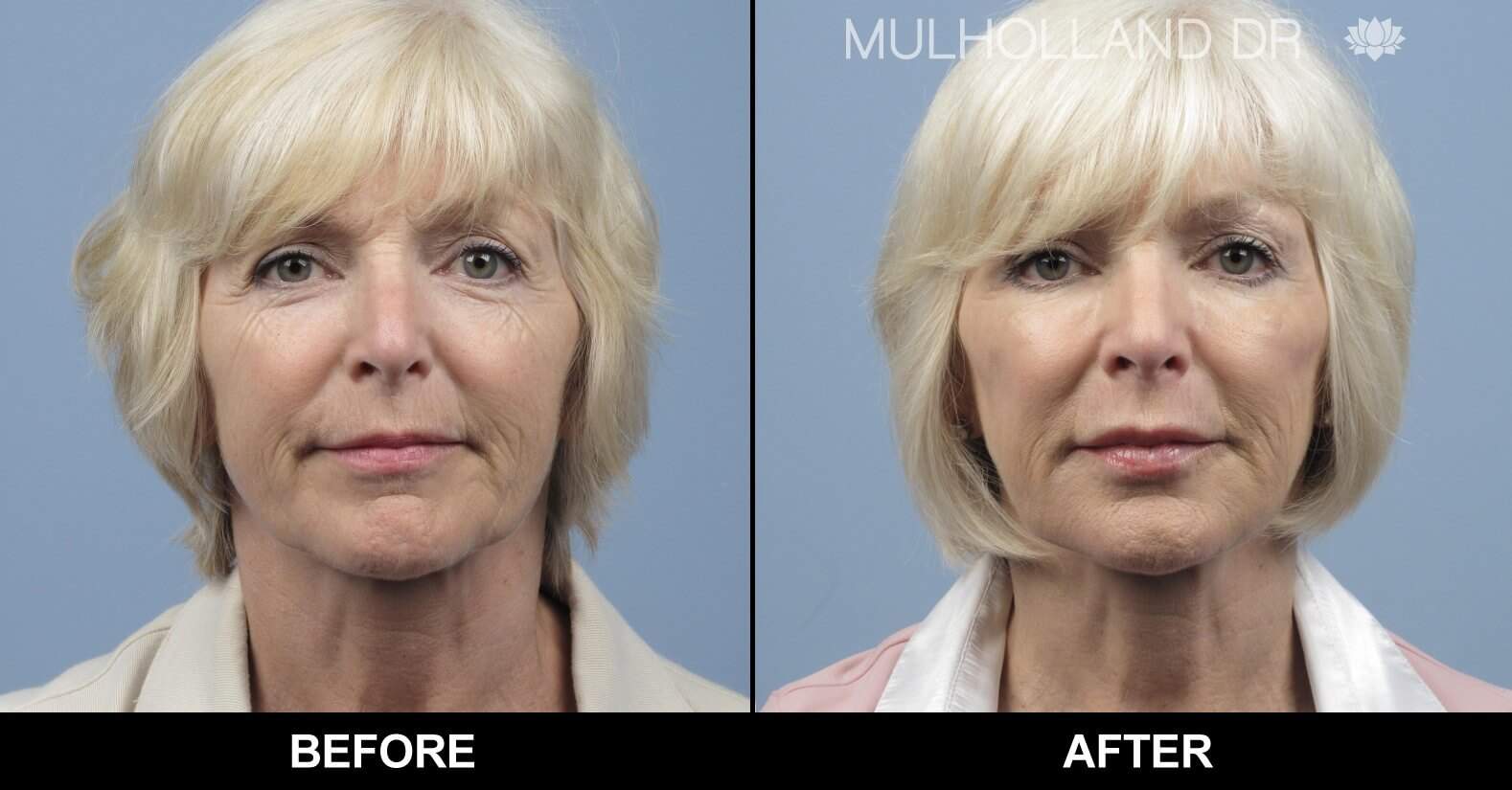 Fractional Erbium Laser - Before and After Gallery - Patient Photo 8