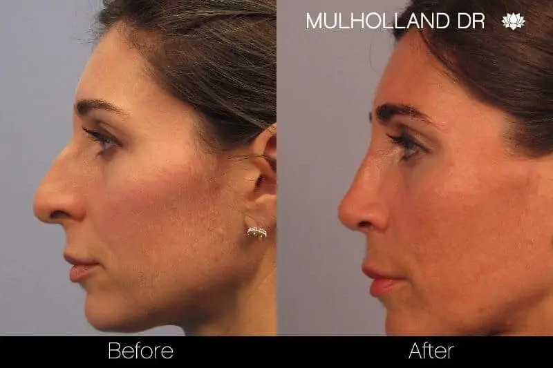 Rhinoplasty - Before and After Gallery - Patient Photo 42