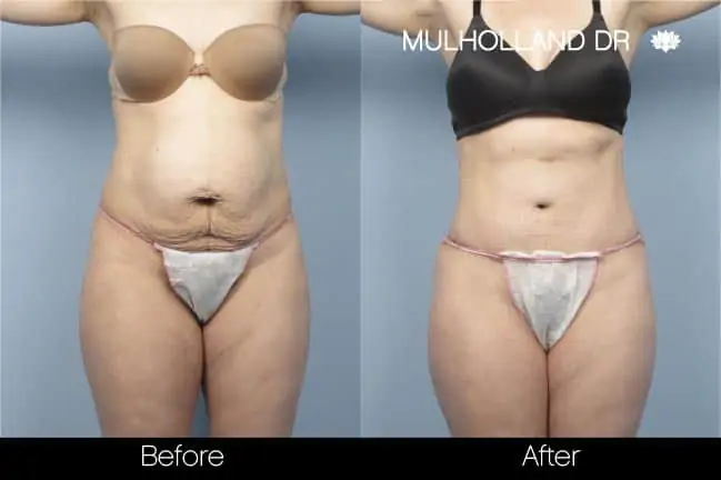 Mini Tummy Tuck - Before and After Gallery - Patient Photo 15