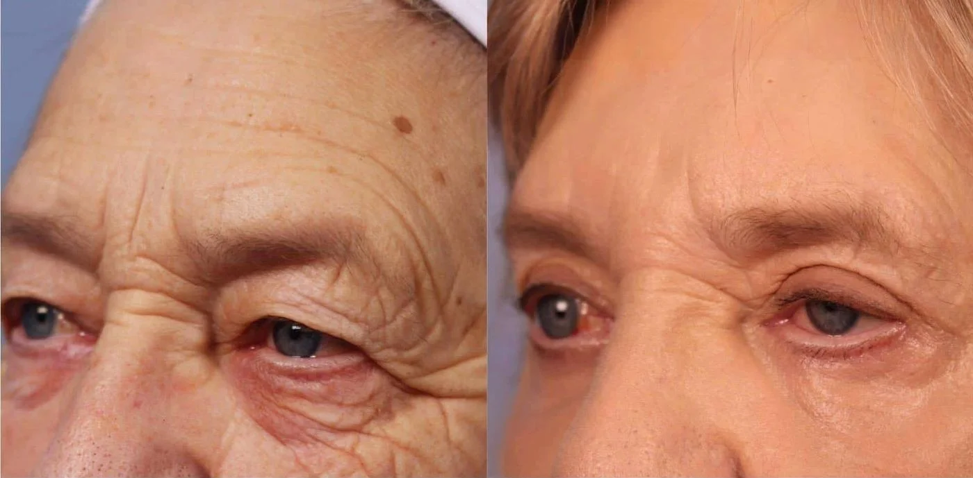 Blepharoplasty - Before and After Gallery – Photo 10