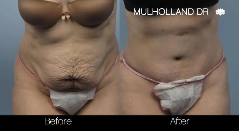 Mini Tummy Tuck - Before and After Gallery - Patient Photo 14