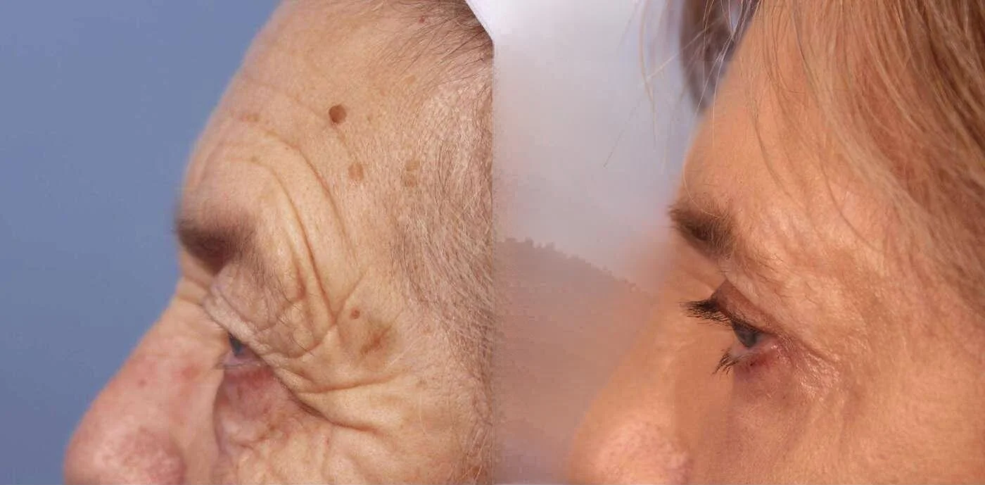 Blepharoplasty - Before and After Gallery – Photo 11