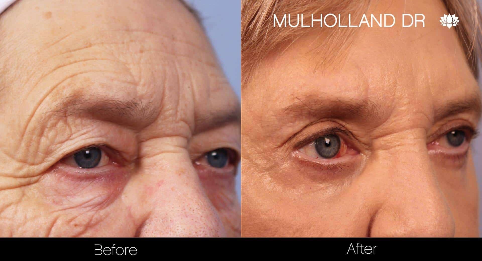 Blepharoplasty - Before and After Gallery – Photo 12