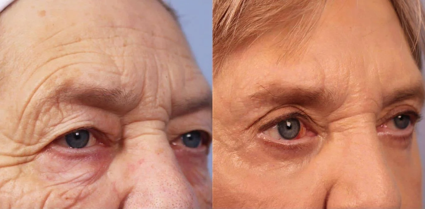 Blepharoplasty - Before and After Gallery – Photo 12
