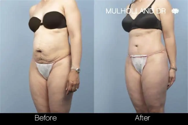 Mini Tummy Tuck - Before and After Gallery - Patient Photo 12