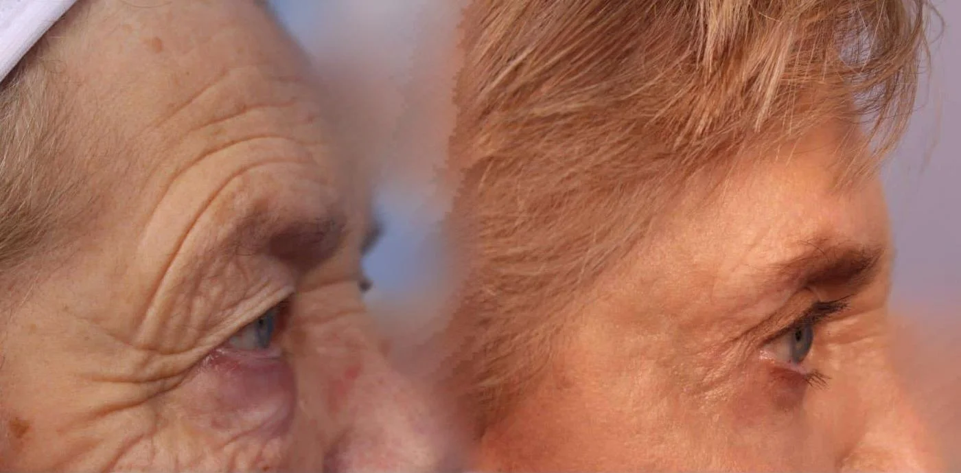 Blepharoplasty - Before and After Gallery – Photo 13