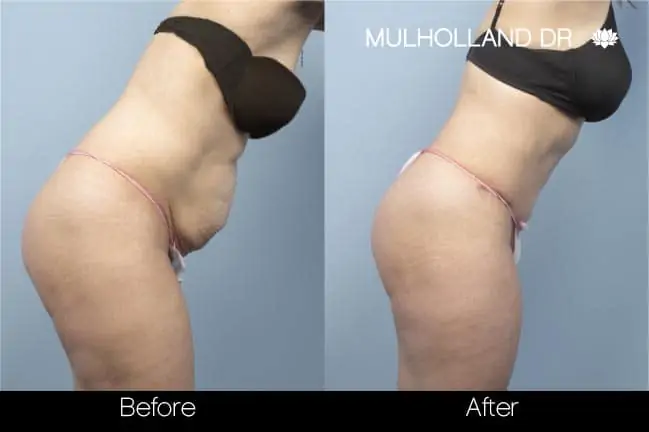 Mini Tummy Tuck - Before and After Gallery - Patient Photo 11