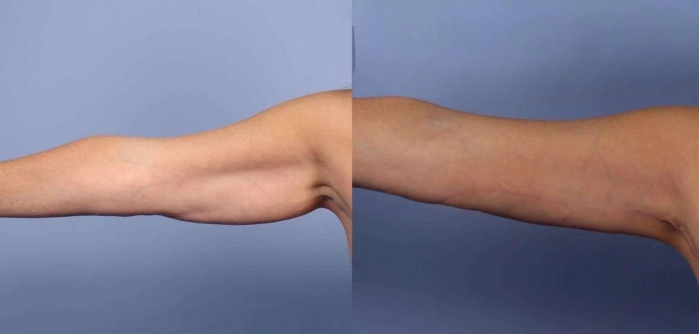 Brachioplasty (Arm Lift) | Toronto Plastic Surgeons Wellness Centre