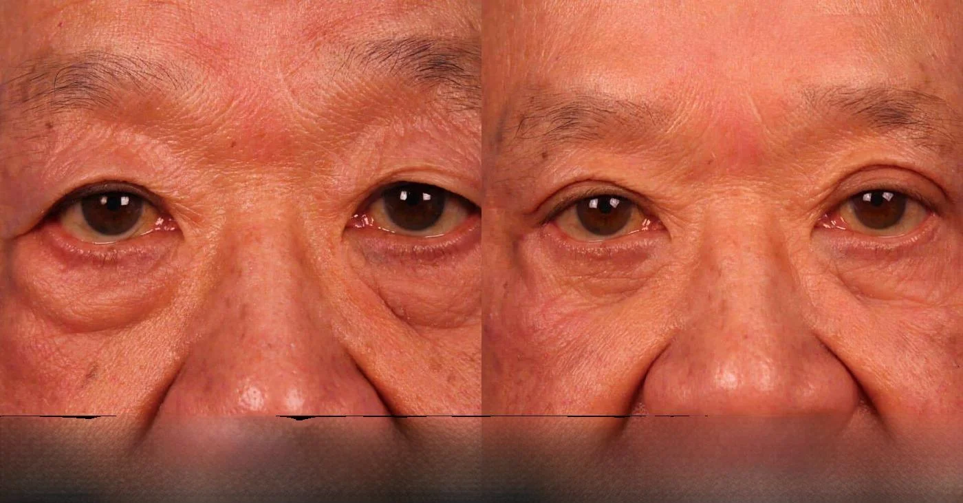 Blepharoplasty - Before and After Gallery – Photo 14
