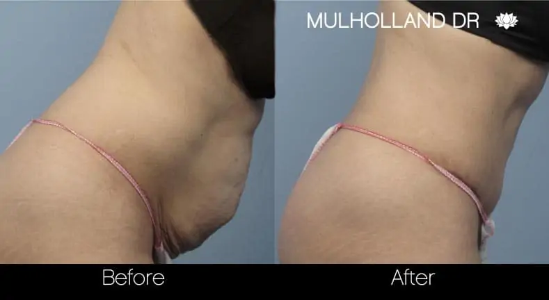 Mini Tummy Tuck - Before and After Gallery - Patient Photo 10