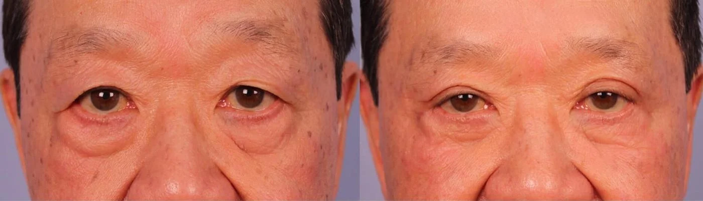 Blepharoplasty - Before and After Gallery – Photo 15