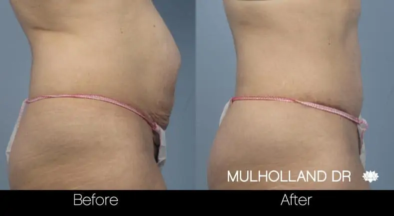 Mini Tummy Tuck - Before and After Gallery - Patient Photo 9