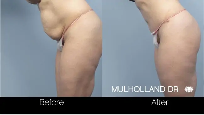 Mini Tummy Tuck - Before and After Gallery - Patient Photo 8