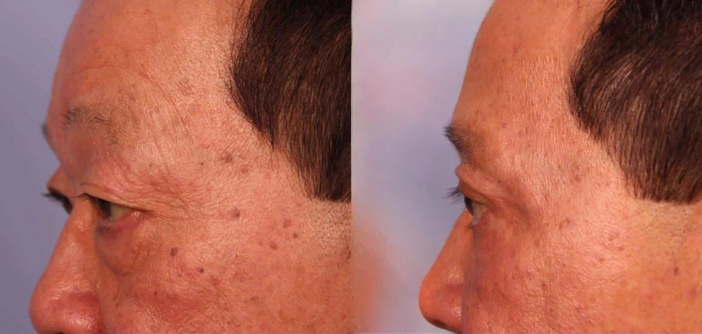 Blepharoplasty - Before and After Gallery – Photo 17