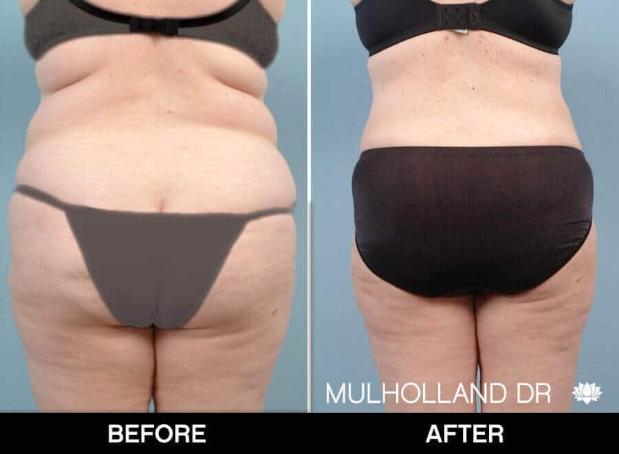 BodyTite Liposuction - Before and After Gallery - Patient Photo 18