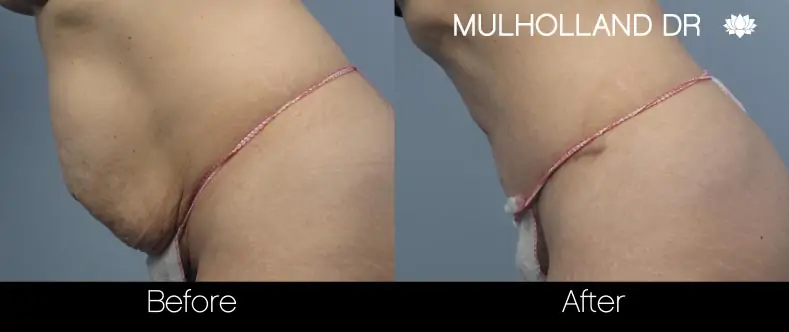 Mini Tummy Tuck - Before and After Gallery - Patient Photo 7