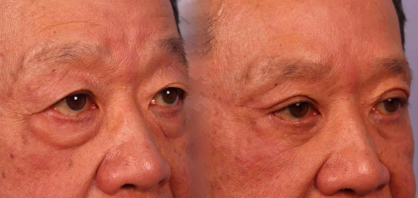 Blepharoplasty - Before and After Gallery – Photo 18