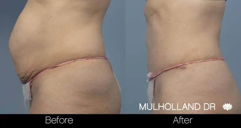Mini Tummy Tuck - Before and After Gallery - Patient Photo 6