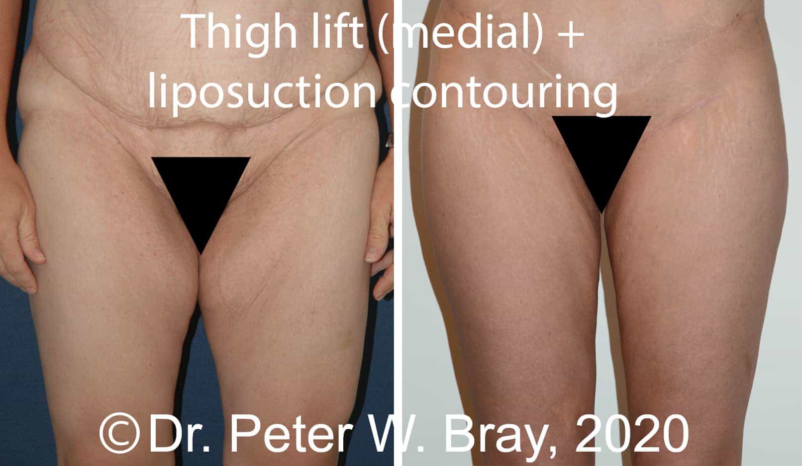 Thigh Lift - Before and After Gallery – Photo 1