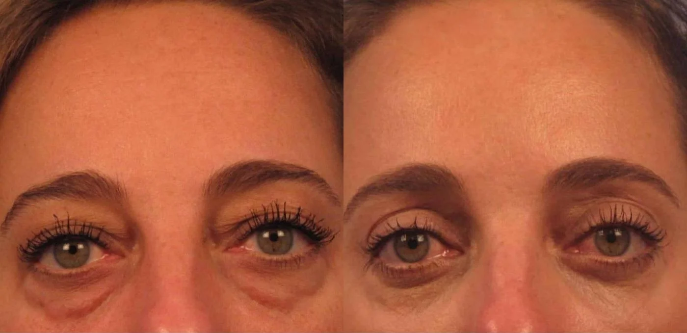 Blepharoplasty - Before and After Gallery – Photo 1