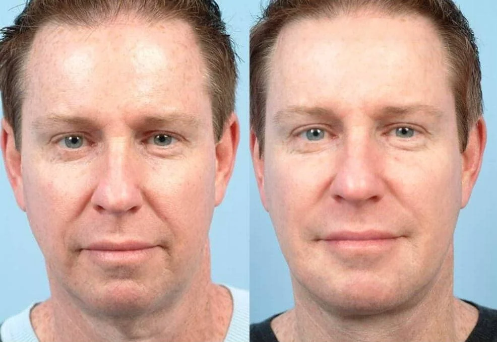 Male Neck Lift - Before and After Gallery – Photo 1
