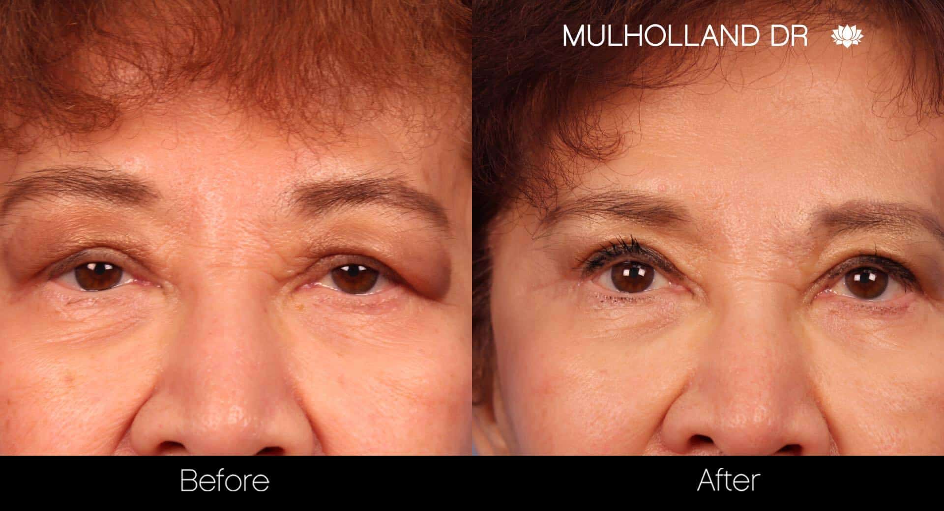 Blepharoplasty - Before and After Gallery – Photo 20