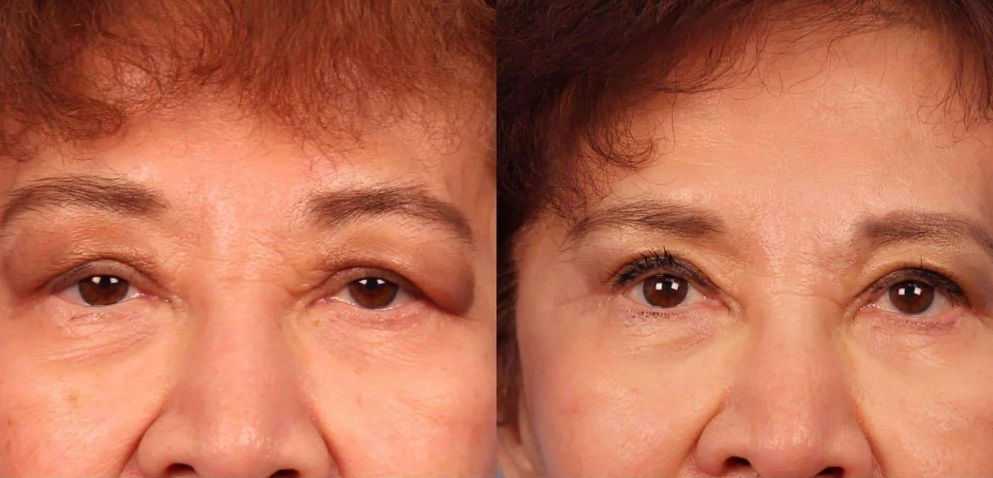 Blepharoplasty - Before and After Gallery – Photo 20