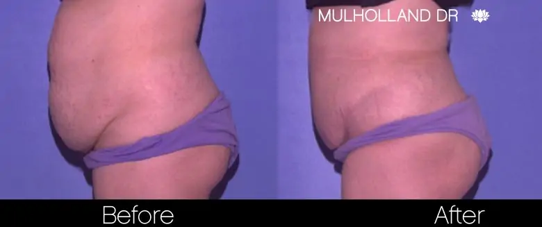 Mini Tummy Tuck - Before and After Gallery - Patient Photo 5