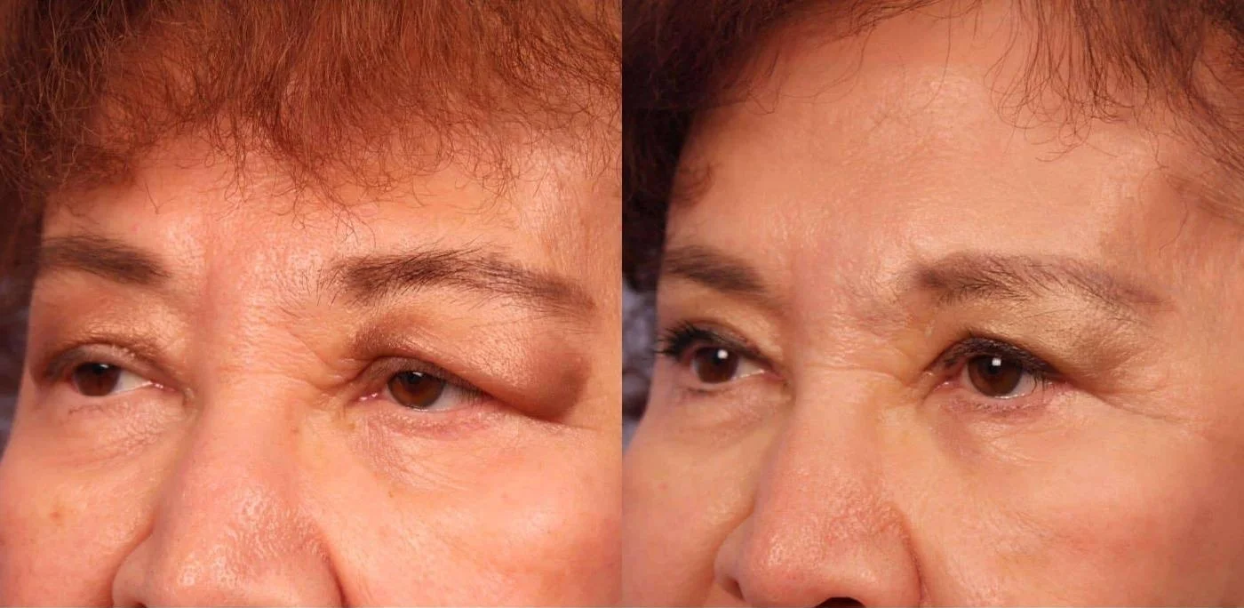 Blepharoplasty - Before and After Gallery – Photo 21