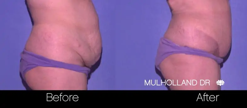 Mini Tummy Tuck - Before and After Gallery - Patient Photo 4