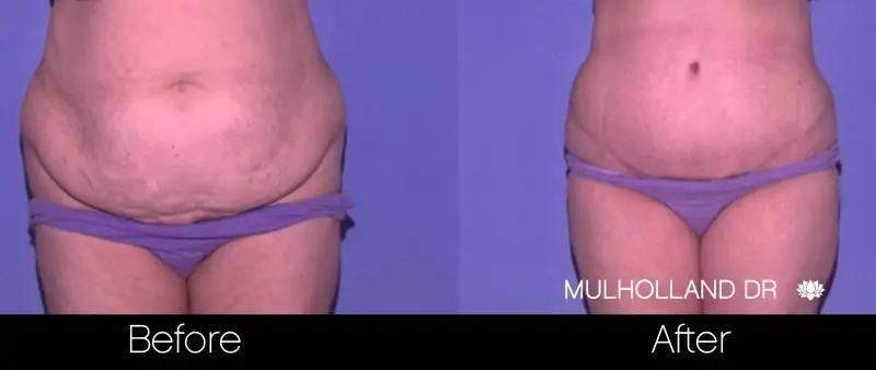 Mini Tummy Tuck - Before and After Gallery - Patient Photo 3