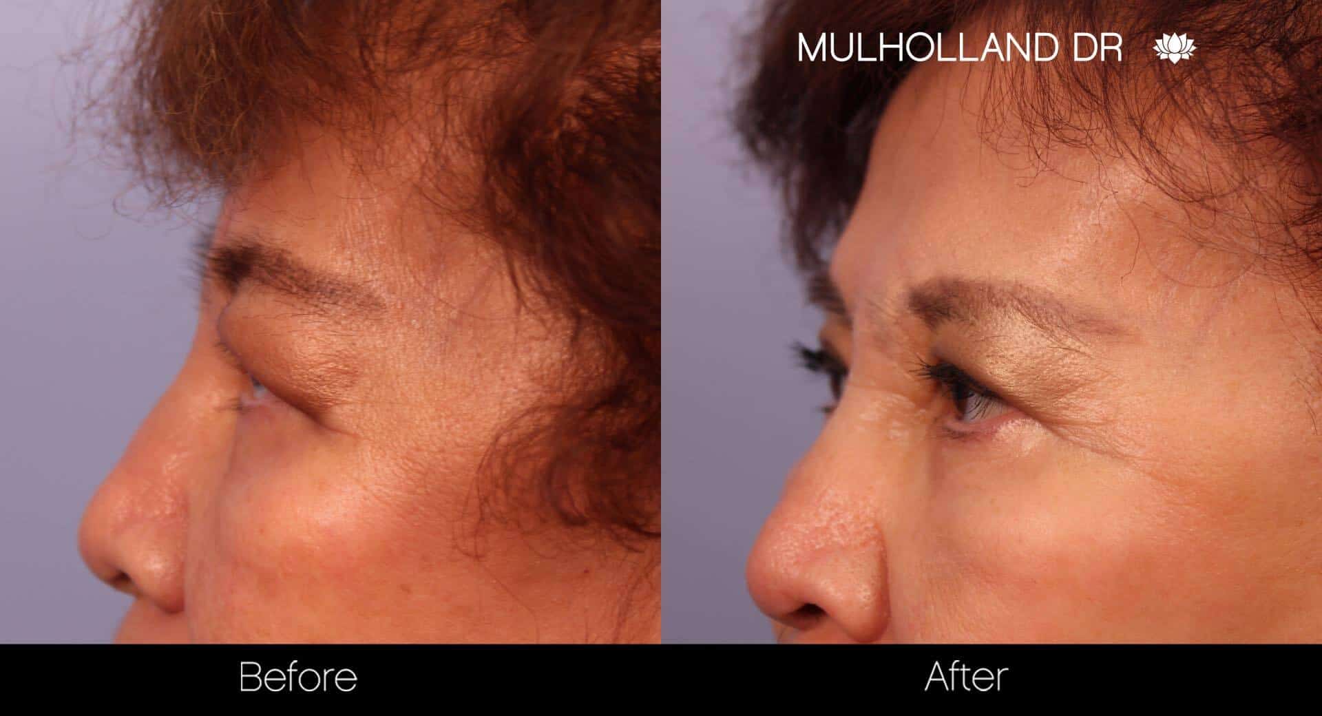 Blepharoplasty - Before and After Gallery – Photo 23