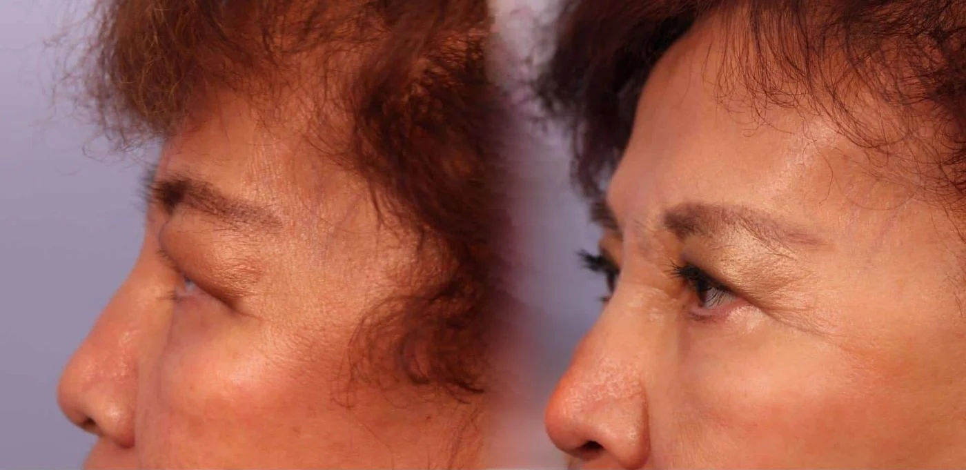 Blepharoplasty - Before and After Gallery – Photo 23