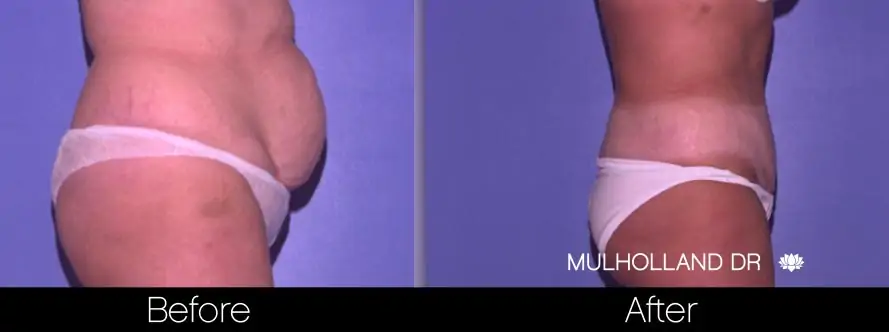 Mini Tummy Tuck - Before and After Gallery - Patient Photo 2