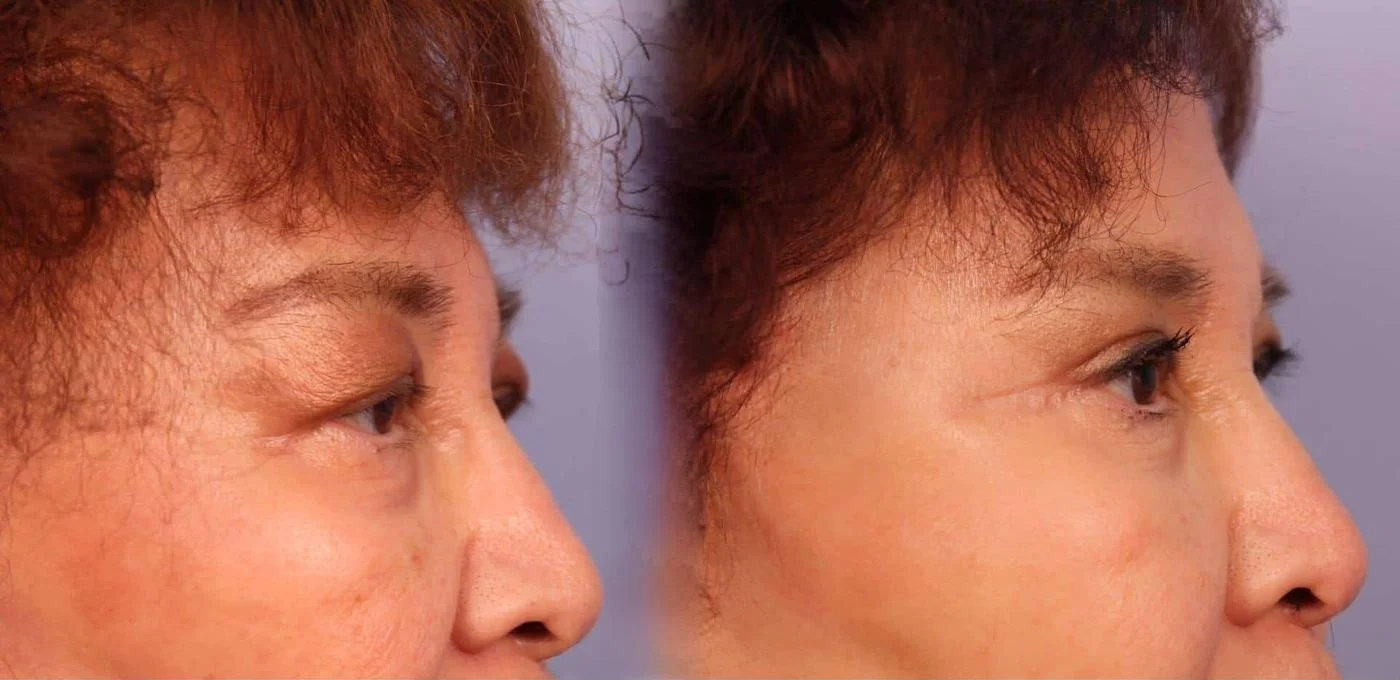 Blepharoplasty - Before and After Gallery – Photo 24