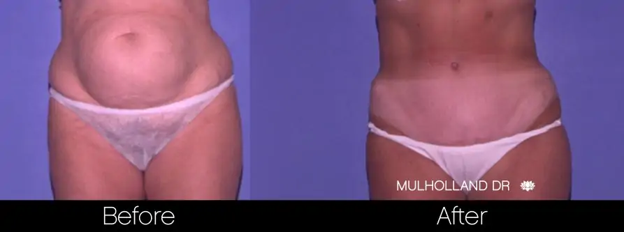 Mini Tummy Tuck - Before and After Gallery - Patient Photo 1