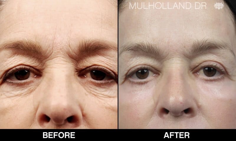 Blepharoplasty - Before and After Gallery – Photo 26