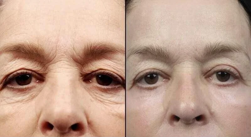 Blepharoplasty - Before and After Gallery – Photo 26