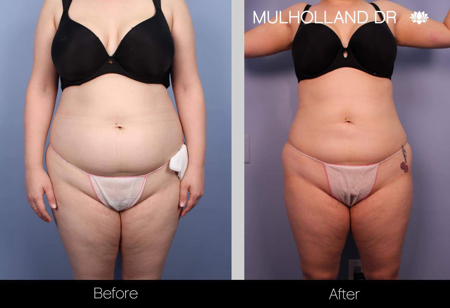 Body Lift - Before and After Gallery – Photo 29