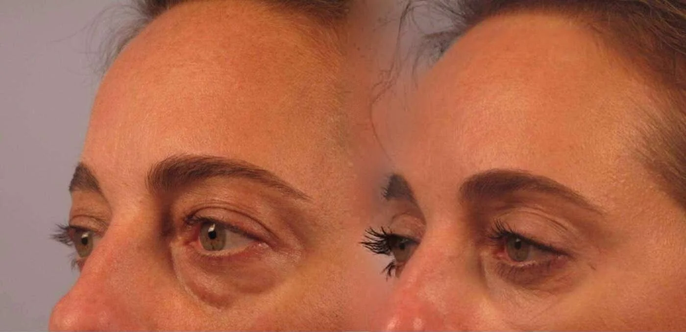 Blepharoplasty - Before and After Gallery – Photo 2