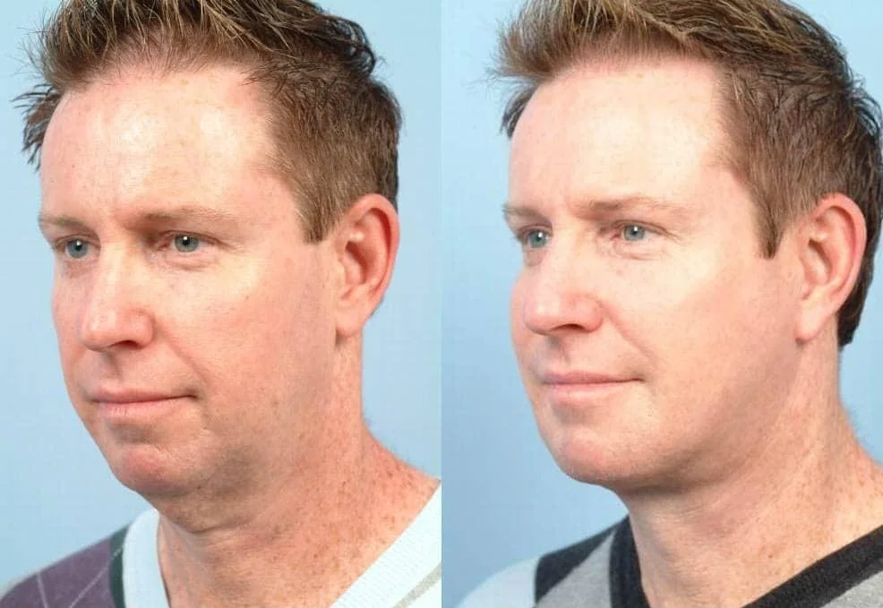 Male Neck Lift - Before and After Gallery – Photo 2