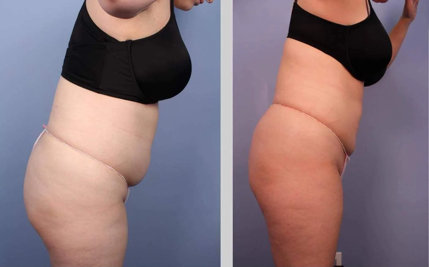 tirzepatide+glycine Preserving Muscle While Losing Fat: Why Tirzepatide with Glycine Is Gaining Ground