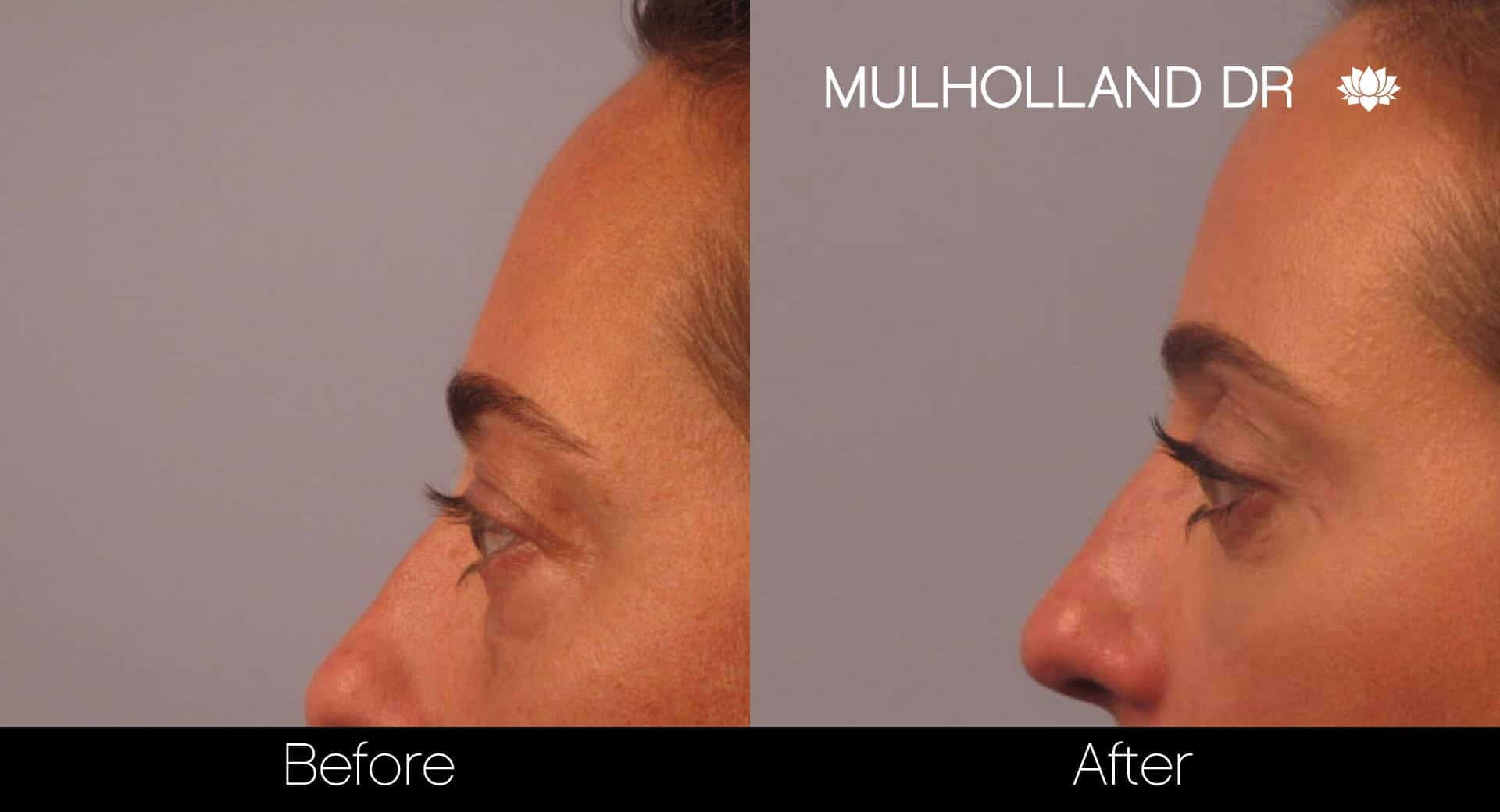 Blepharoplasty - Before and After Gallery – Photo 3