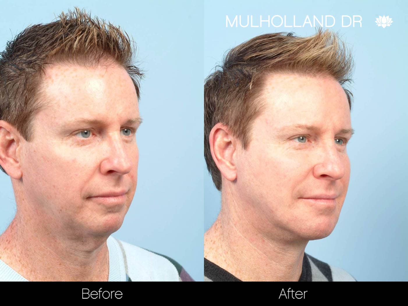 Male Neck Lift - Before and After Gallery – Photo 3