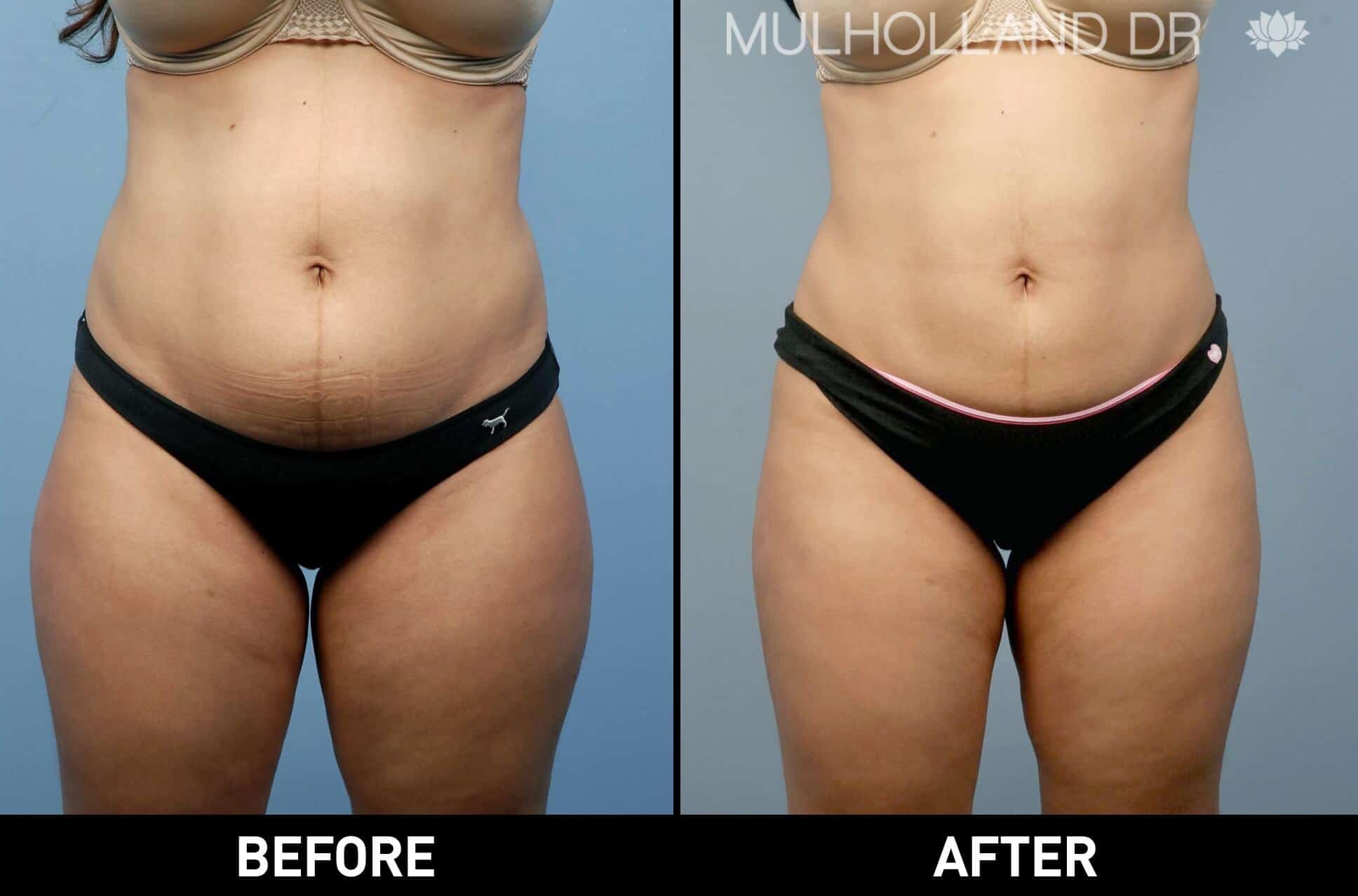 Vaser Liposuction - Before and After Gallery - Patient Photo 1