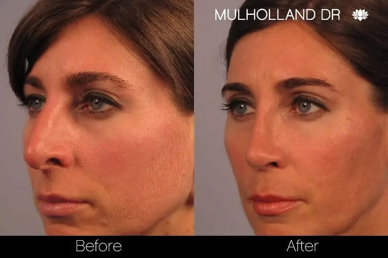 Rhinoplasty - Before and After Gallery - Patient Photo 1